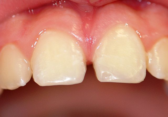 Clínica Dental Dr. Bienvenido Pérez Mombiela dientes de niño