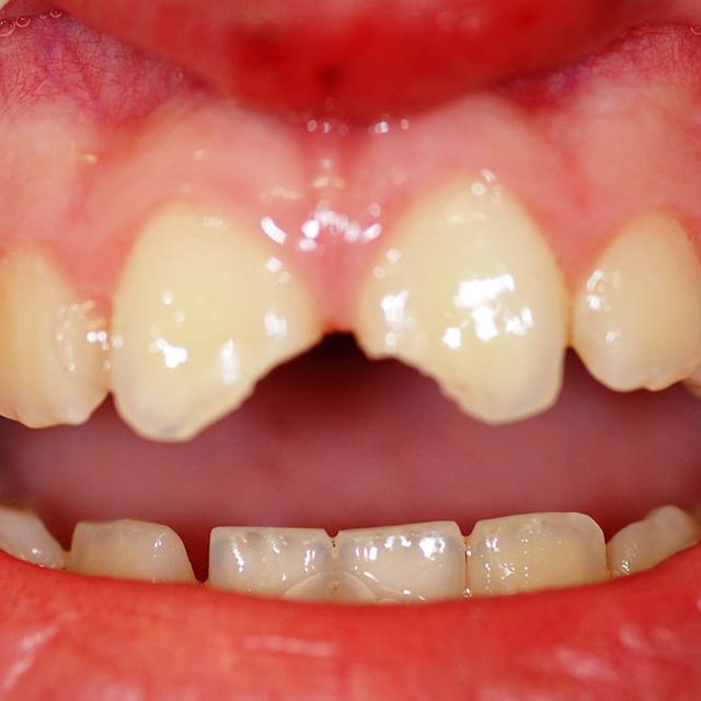 Clínica Dental Dr. Bienvenido Pérez Mombiela dientes torcidos
